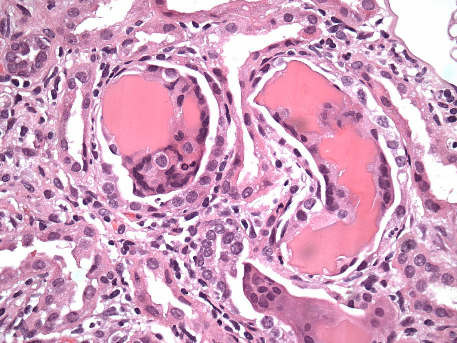 Renal Pathology | Pathology